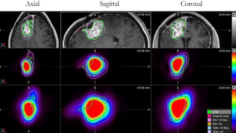 UT Health San Antonio develops drug found to more than double survival time for glioblastoma patients